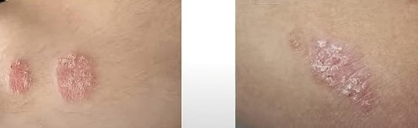 
        Синдром активации тучных клеток. Почему не всегда возможно добиться контроля течения аллергических заболеваний?                    