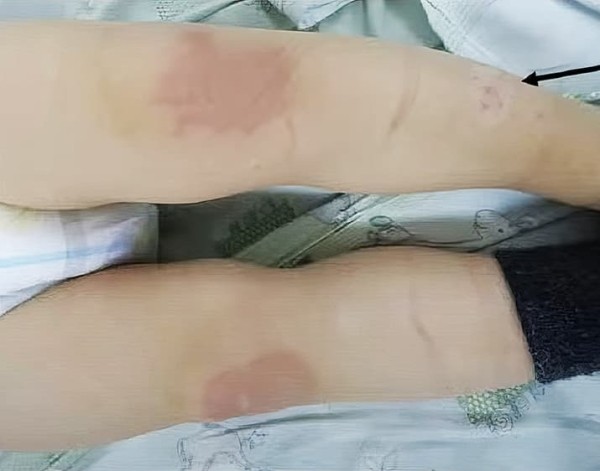 
        Синдром активации тучных клеток. Почему не всегда возможно добиться контроля течения аллергических заболеваний?                    