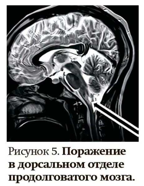 Заболевания спектра оптиконейромиелита
Заболевания спектра оптиконейромиелита