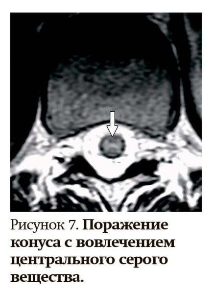 Заболевания спектра оптиконейромиелита
Заболевания спектра оптиконейромиелита