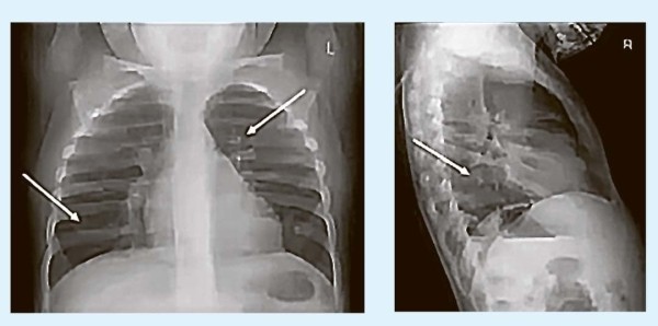Кашель у детей: особенности дифференциальной диагностики
Кашель у детей: особенности дифференциальной диагностики