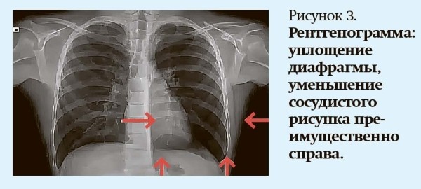 Кашель у детей: особенности дифференциальной диагностики
Кашель у детей: особенности дифференциальной диагностики