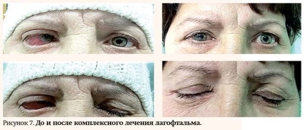 Особенности лечения пациентов с различными видами лагофтальма
Особенности лечения пациентов с различными видами лагофтальма