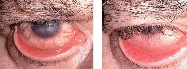 Особенности лечения пациентов с различными видами лагофтальма
Особенности лечения пациентов с различными видами лагофтальма