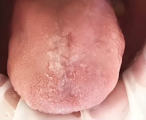 ГЭРБ снимает «маску»: стоматологические проявления, под которыми прячется заболевание + аудио
ГЭРБ снимает «маску»: стоматологические проявления, под которыми прячется заболевание + аудио