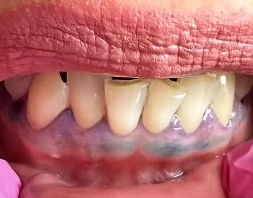 ГЭРБ снимает «маску»: стоматологические проявления, под которыми прячется заболевание + аудио
ГЭРБ снимает «маску»: стоматологические проявления, под которыми прячется заболевание + аудио