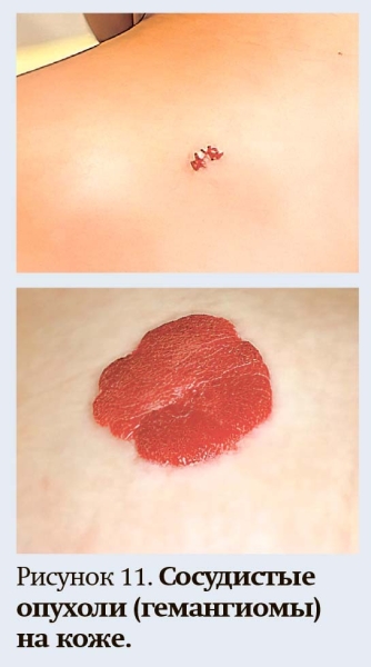 Геморрагический синдром: клиническая оценка и тесты
Геморрагический синдром: клиническая оценка и тесты