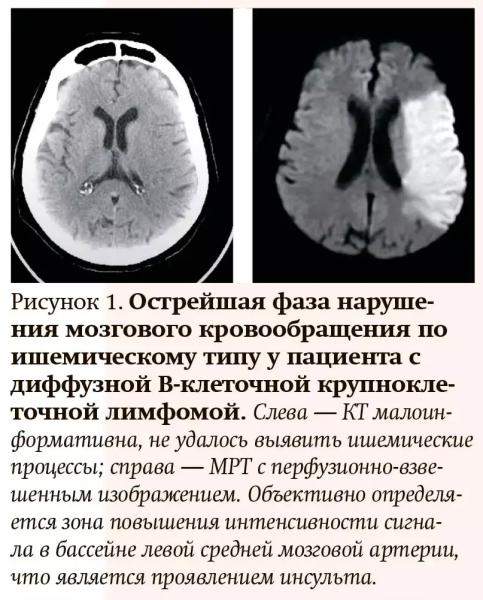 Лучевая диагностика при кровотечениях и тромбозах: плюсы и минусы разных методов
Лучевая диагностика при кровотечениях и тромбозах: плюсы и минусы разных методов