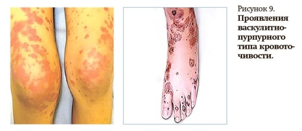 Геморрагический синдром: клиническая оценка и тесты
Геморрагический синдром: клиническая оценка и тесты