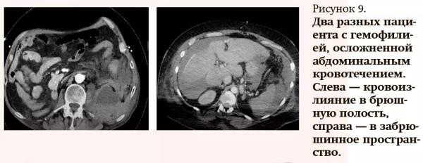 Лучевая диагностика при кровотечениях и тромбозах: плюсы и минусы разных методов
Лучевая диагностика при кровотечениях и тромбозах: плюсы и минусы разных методов
