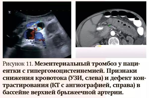 Лучевая диагностика при кровотечениях и тромбозах: плюсы и минусы разных методов
Лучевая диагностика при кровотечениях и тромбозах: плюсы и минусы разных методов