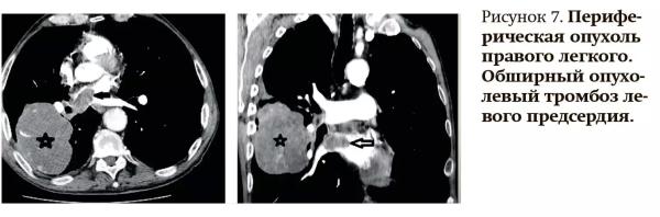 Лучевая диагностика при кровотечениях и тромбозах: плюсы и минусы разных методов
Лучевая диагностика при кровотечениях и тромбозах: плюсы и минусы разных методов