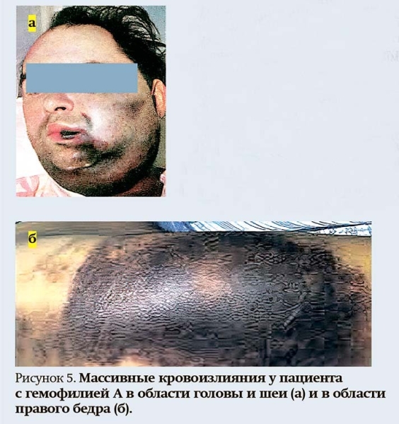 Геморрагический синдром: клиническая оценка и тесты
Геморрагический синдром: клиническая оценка и тесты