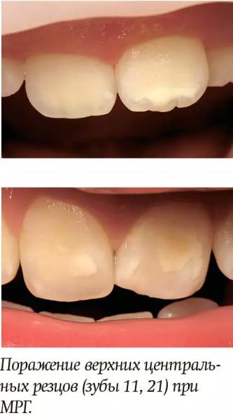 Диагностика и лечение молярно-резцовой гипоминерализации у детей + аудио
Диагностика и лечение молярно-резцовой гипоминерализации у детей + аудио