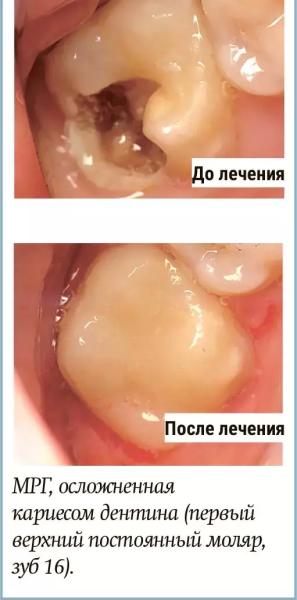 Диагностика и лечение молярно-резцовой гипоминерализации у детей + аудио
Диагностика и лечение молярно-резцовой гипоминерализации у детей + аудио