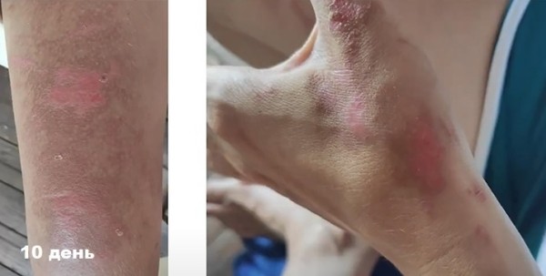 
        Фотодерматозы: фототоксические ожоги, аллергические реакции и солнечная крапивница                    