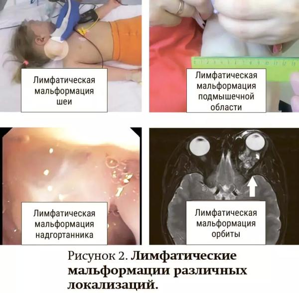 
        Лимфатические мальформации — от хирургии к таргетной терапии                     