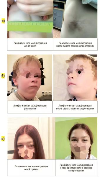 
        Лимфатические мальформации — от хирургии к таргетной терапии                     