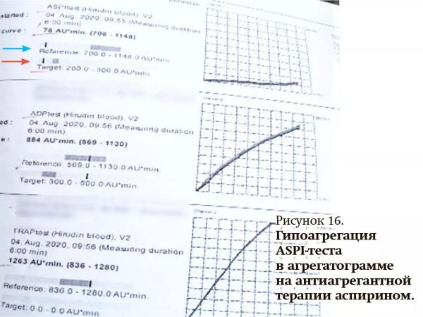 
        Первичный гемостаз и методы его оценки: оптическая и импедансная агрегатометрия                     