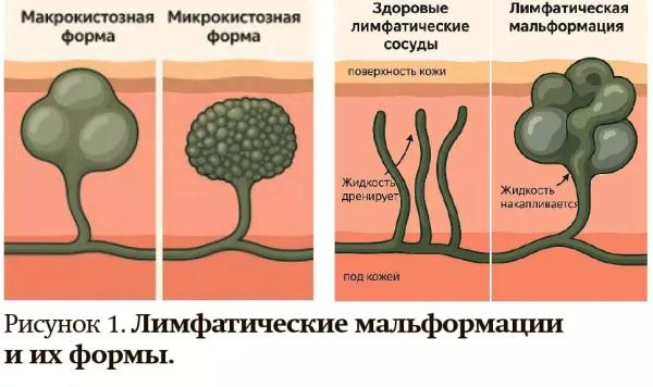 
        Лимфатические мальформации — от хирургии к таргетной терапии                     
